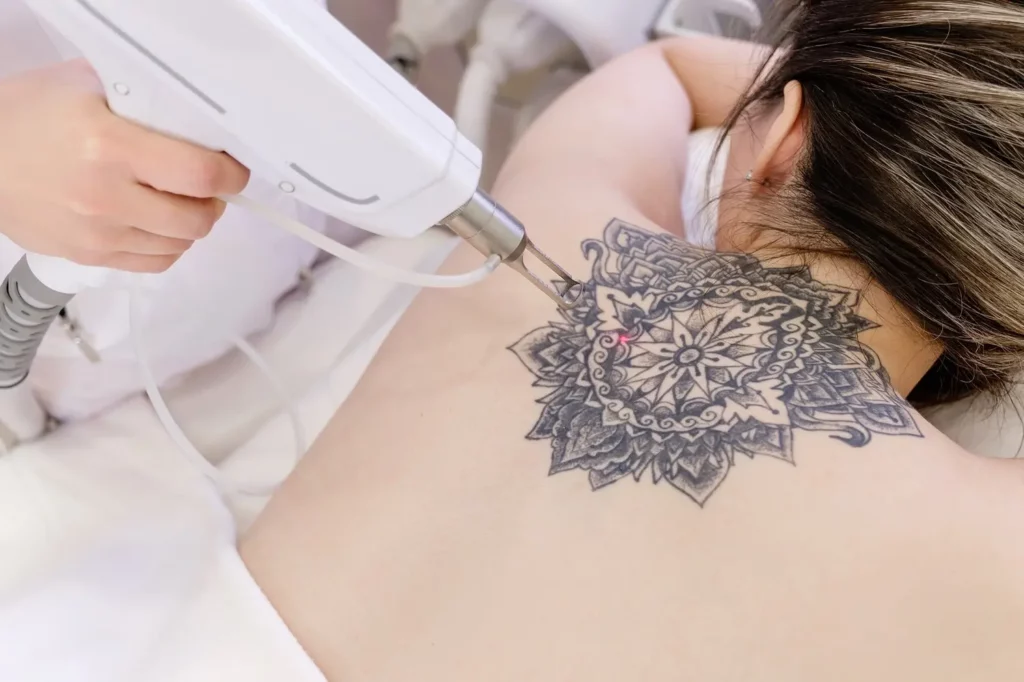 Tattoo Removal Service by Grand Valley Laser Aesthetics in grand junction, CO