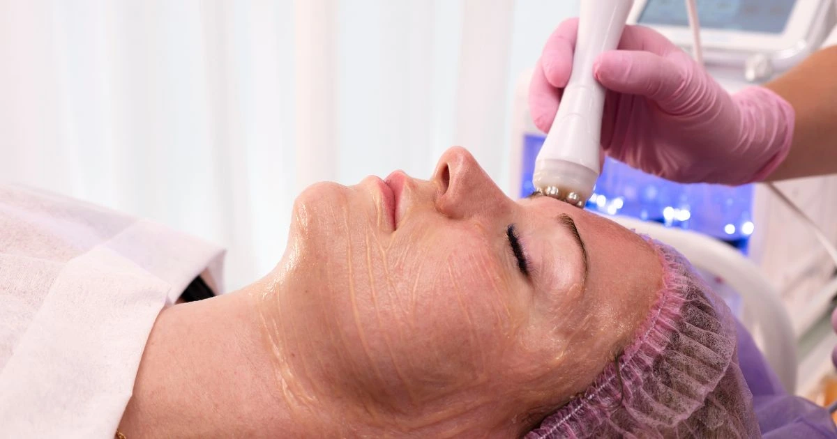 Micropeel in grand junction, CO by Grand Valley Laser Aesthetic